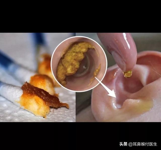 耳屎堵住耳朵自救方法,孩子耳朵里有耳屎堵塞可以掏一掏吗