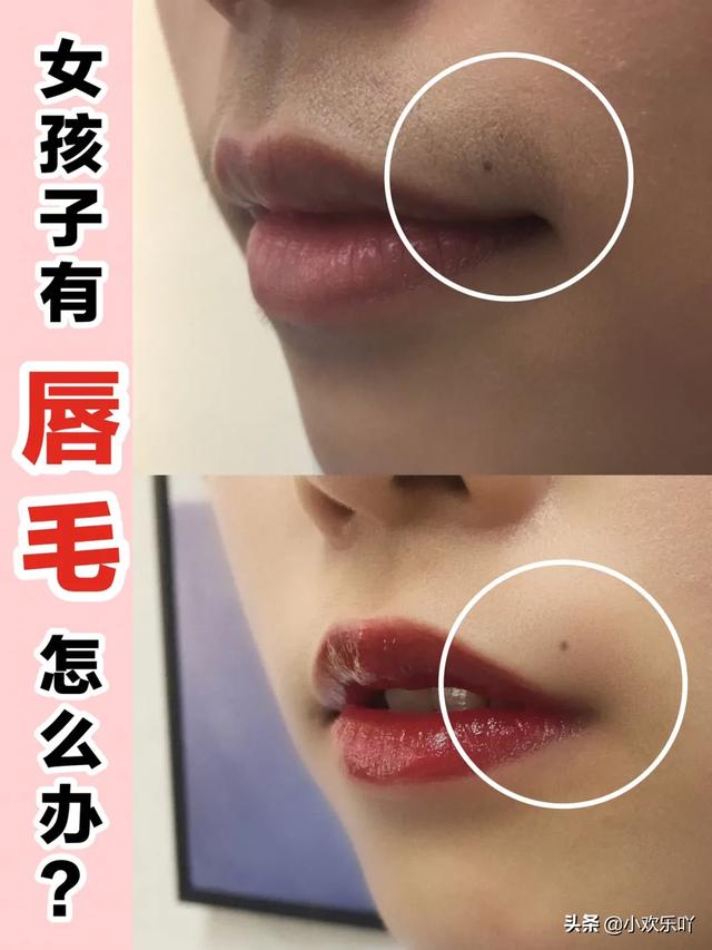 大家知道如何去掉唇毛吗?