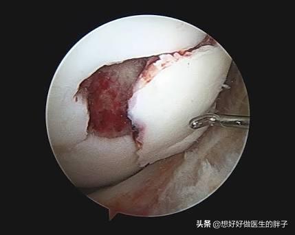 髌骨脱位:孩子做了关节镜手术2个月了，可以跑步和跳绳了吗？