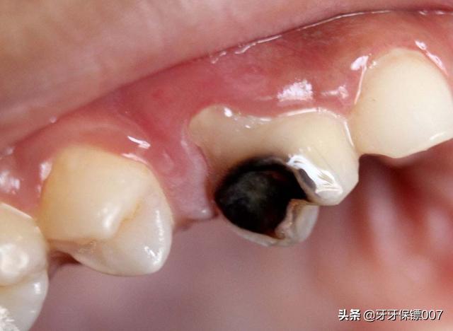 儿童补牙(儿童补牙一般多少钱一颗)