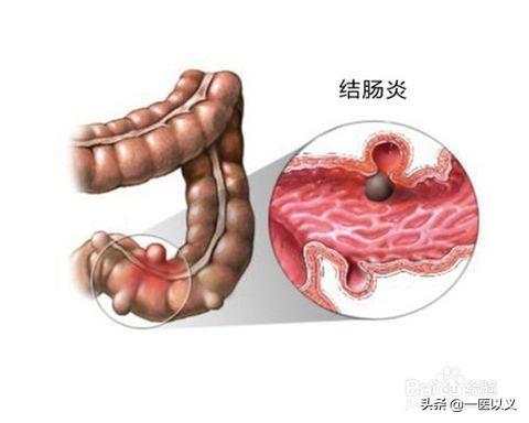 预防肠道疾病教学设计:幼儿园预防肠道疾病教案 引起肠癌的原因有哪些？肠癌能预防吗？