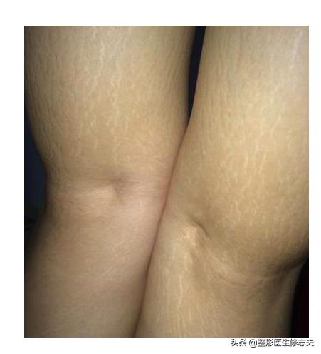 头条问答 - 有生长纹和肥胖纹是什么体验?(3个回答)