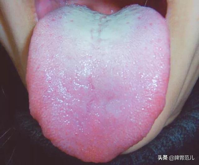 舌苔青紫色的图片图片