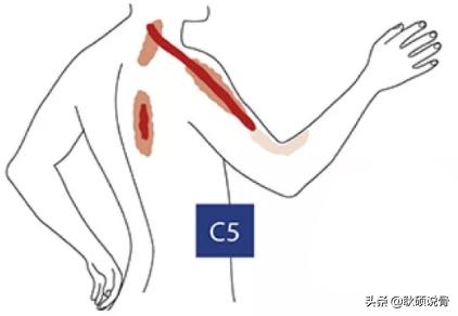 颈神经根炎的症状与治疗:颈椎椎间盘突出C3C4C5压迫神经根及硬膜囊是什么症状？