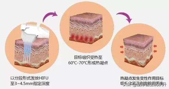 为斯宝赛级怎么样:超声刀的效果真有那么神奇吗？