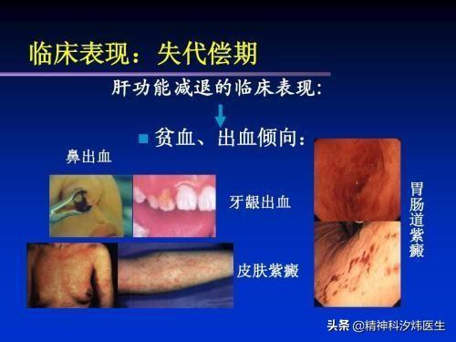 纳差是什么意思啊,为什么肝硬化腹水没力气？