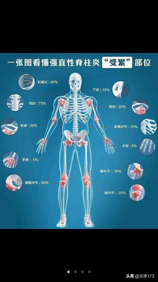 脊柱病 大腕:强制性脊柱炎的研究现在到底有没有进展？