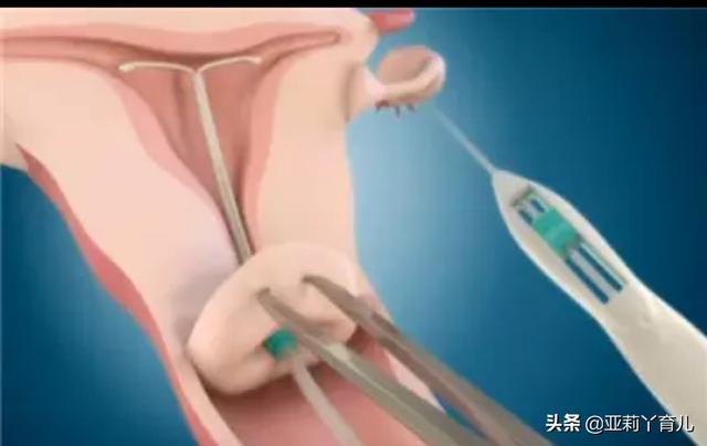 绝育药:男性结扎的好处和坏处有哪些？