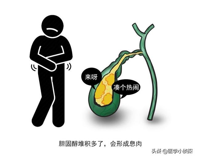 三大抗癌石,胆囊息肉、胆结石会转化为胆囊癌吗？