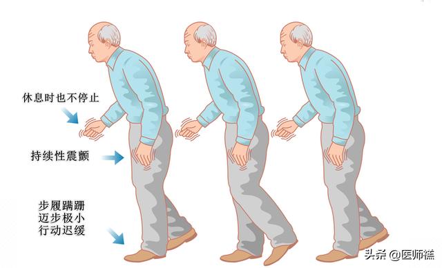 莱姆病症状早期以:帕金森综合症早期症状有哪些？