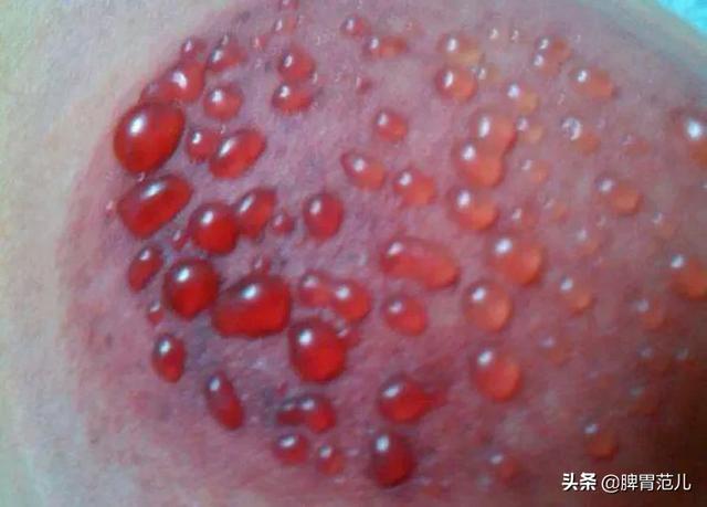 怎样才能有效的去除湿气？拔血罐真的管用吗？