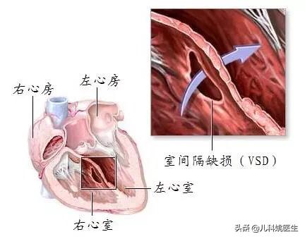 先天性心脏病的症状:先天性心脏病的症状主要是 心脏病能否引起呼吸道感染、流鼻涕、流泪、鼻塞和咳嗽等症状呢？