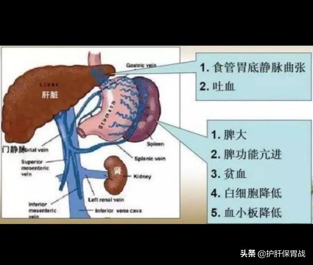 吃动物肝脏拉的大便黑吗:肝硬化输液补铁能出现黑便吗？