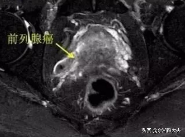 药物去势:药物去势是什么意思 前列癌内分泌治疗多久复查？