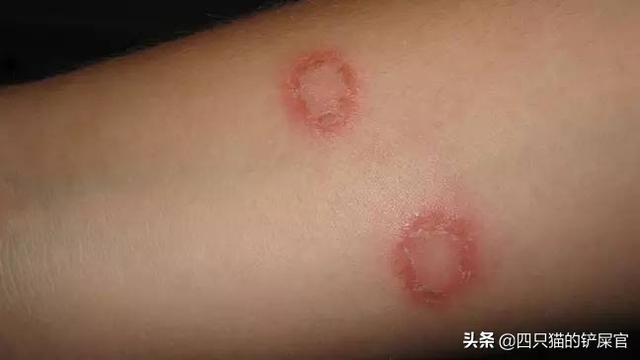 头条问答 - 养猫人会感染哪些皮肤病?(18个回答)