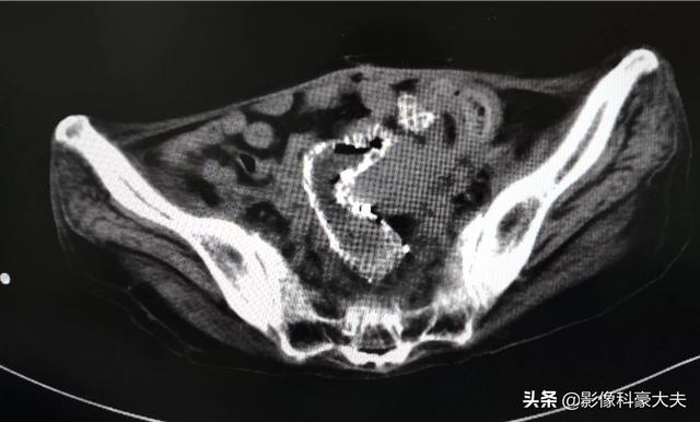 化疗什么情况下用红药水:化疗用的红药水叫什么 癌症化疗时出血，是肿瘤恶化了吗？