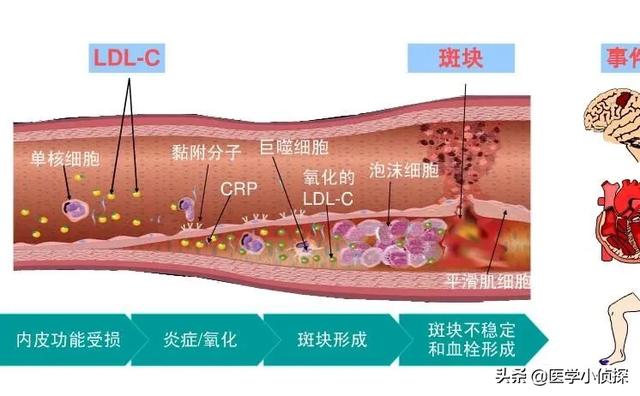 怎么知道自己的血脂高不高血脂高的话怎么办