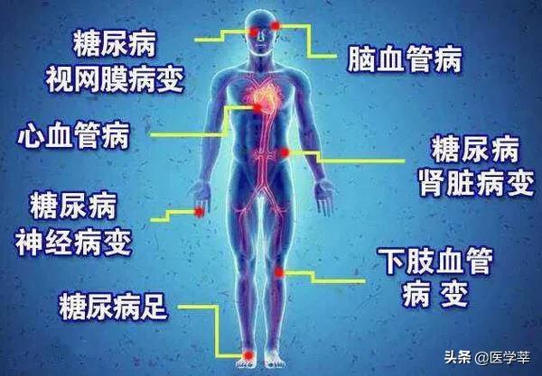 隐形糖尿病有哪些症状:如何判断自己是不是得糖尿病并发症了？