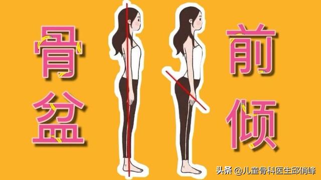 如何判断自己是否骨盆前倾？