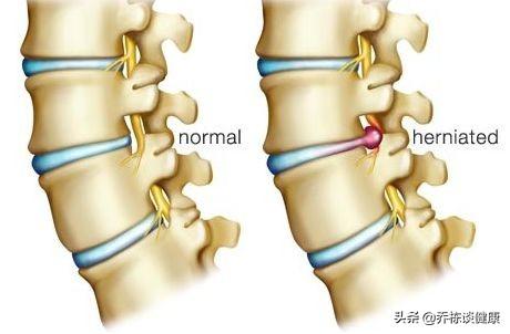 經絡養生你經常腰痛嗎腰間盤突出經常腰疼有什麼方法可以緩解嗎能不能