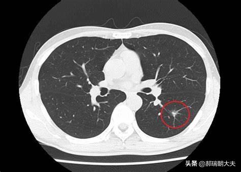 头条问答 肺部ct多久做一次合适 100个回答