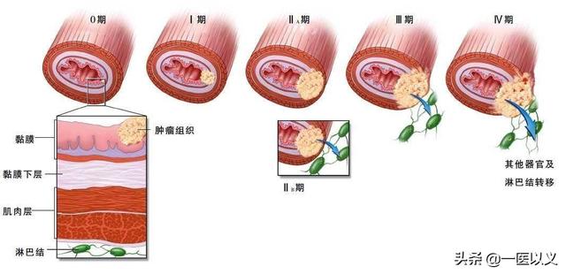 巴氏小体失活的意义是什么:食道癌是什么原因引起的？