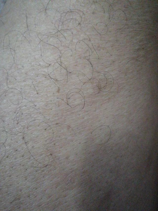 北京治疗皮肤病:银屑病该休息一段时间吗？