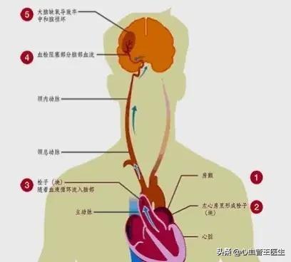 为啥长期脑供血不足会得脑梗塞：脑供血不足与脑梗塞的区别