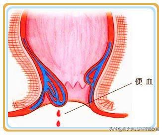 排便前面拉稀带血丝后面正常:大便有黏液血丝怎么回事？