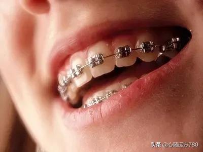 悟空问答 牙齿矫正是怎么样的感受 矫正过程中和矫正后对生活有哪些影响 儒雅小杨同志的回答 0赞