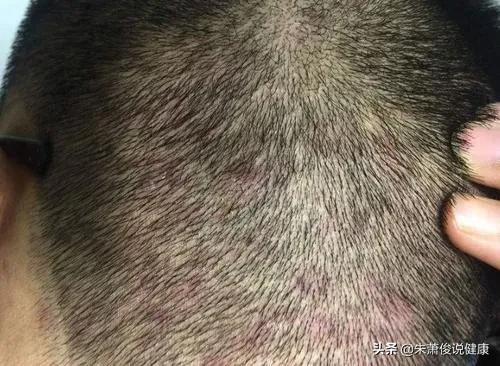 不常见皮肤病症状图片:猪常见皮肤病的症状及图片 头皮里经常长疙瘩，可能有哪些原因？有没有哪些快速消除的办法？