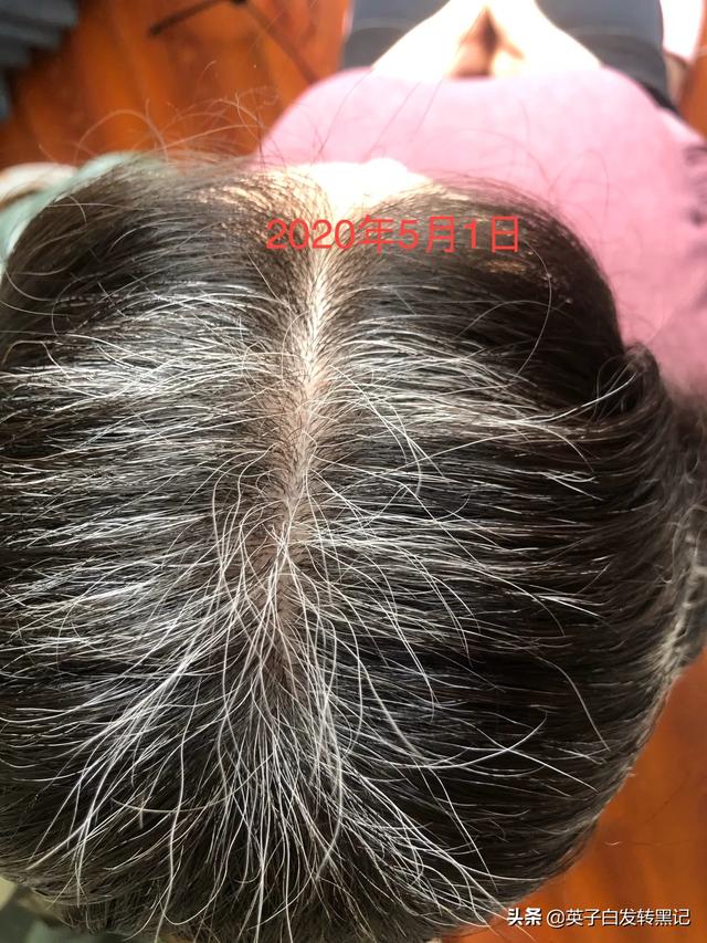 四十岁头发白了很多,染发对身体不好,不染又不甘心,咋办？