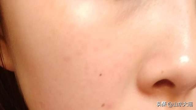 祛红血丝产品排行榜,什么化妆品可以去除红血丝？