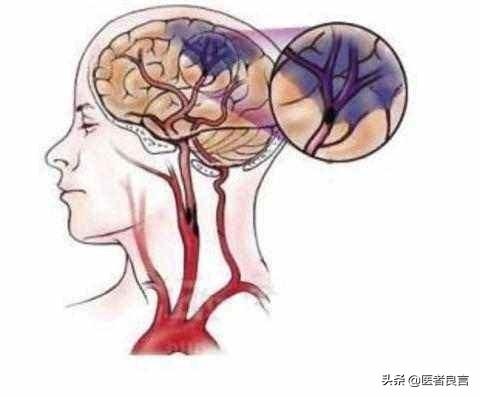 如何识别脑梗的先兆表现，身体出现哪些症状暗示脑梗来袭以及如何预防脑梗