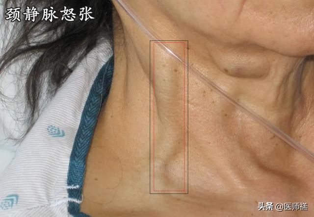 心肌缺血的早期症状,心脏病的早期症状是怎样的？