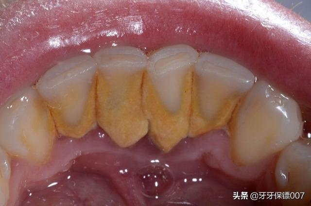 牙结石洗牙多少钱:牙结石洗牙多少钱一颗 有少量牙结石需要洗牙吗？