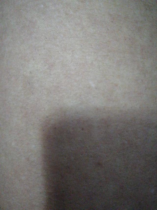 北京治疗皮肤病:银屑病该休息一段时间吗？