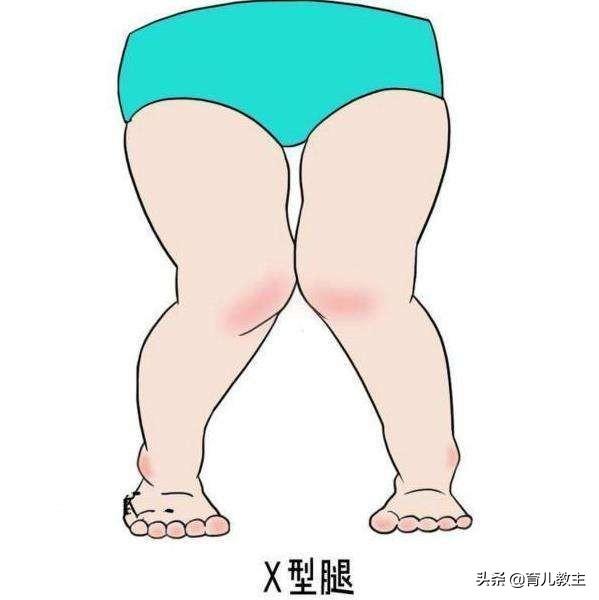 头条问答 - 宝宝走路早真的会罗圈腿吗?(16个回答)