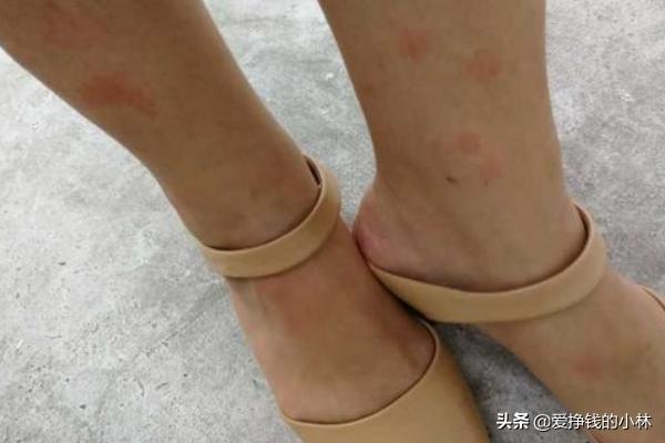 小孩被跳蚤咬的症状图片大全:怎么知道床上有没有跳蚤？