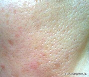 毛孔芝麻:毛孔近看一个个像小洞，还往外流油，这到底是怎么回事？