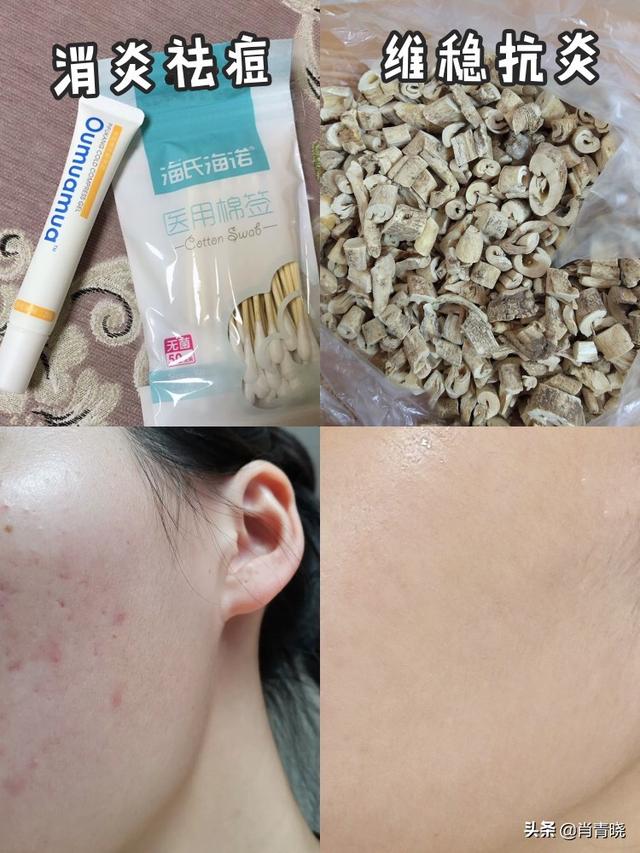 网上那些加微信免费祛痘的是真的吗？(网上加微信祛痘是真的吗)