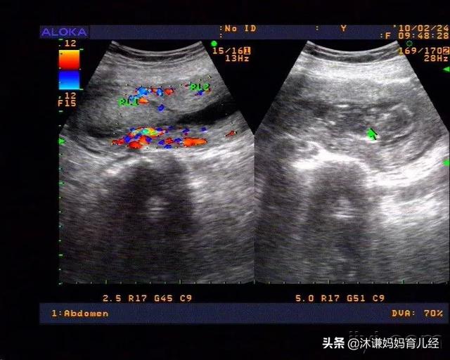 死胎有什么症状:停胎有什么症状。停胎多久能发现？