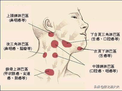 头条问答 淋巴结转移是不是没救了 快乐抗癌的ms陈的回答 0赞