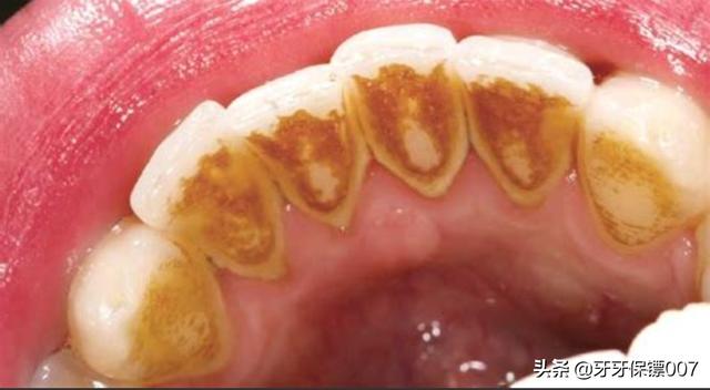 洗牙的好处和坏处,洗牙有啥好处，有副作用吗？