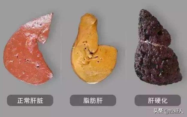 业障重女人的表现,女人肝不好，身体会有哪些表现？如何调养？