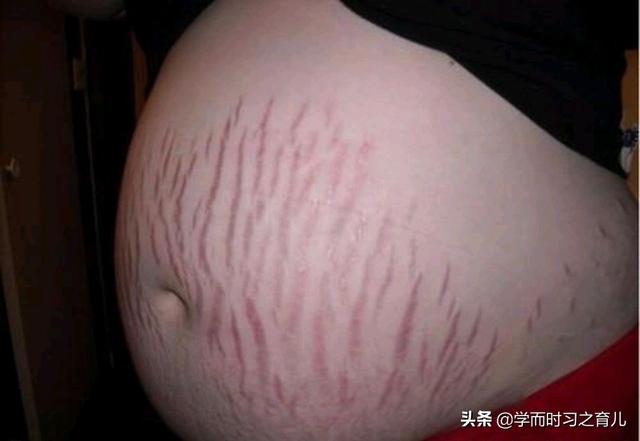 怀孕多久会长妊娠纹，37周长出紫色妊娠纹到生还要长多少？