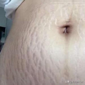 怀孕多久会长妊娠纹？为什么会长妊娠纹？插图45