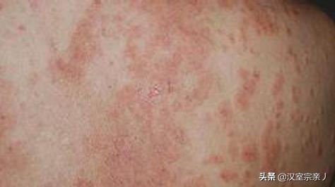 皮炎和湿疹的区别图片,癣和皮炎到底有什么区别？