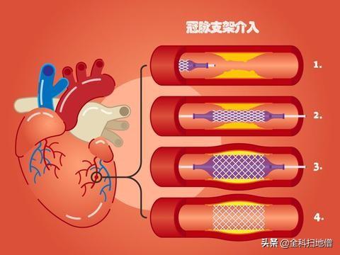 急性心肌梗塞huli:急性心肌梗塞护理 急性心肌梗死，安装心脏支架术后该怎么保养？
