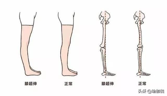 膝关节超生怎么去锻炼？